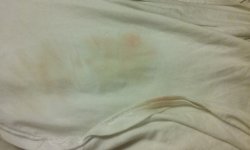 BJ has faint blood in her urine