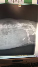 Is this another bladder stone?
